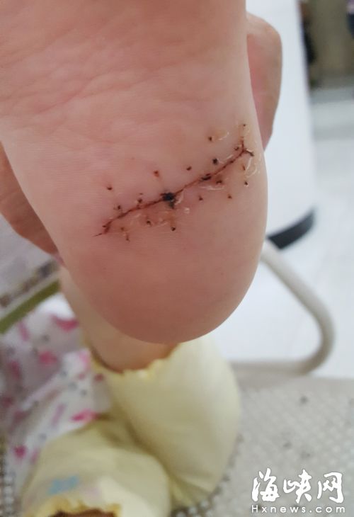 小孩右脚被划破4厘米